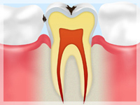C1【エナメル質の虫歯】