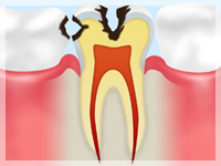 C2【象牙質の虫歯】