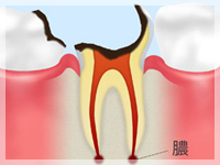 C4【歯根まで達した虫歯】