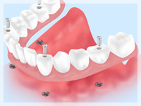 インプラントデンチャー