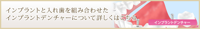 インプラントと入れ歯を組み合わせたインプラントデンチャーについて詳しくはこちら