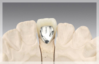 硬質レジン前装冠（前歯のみ保険適用）